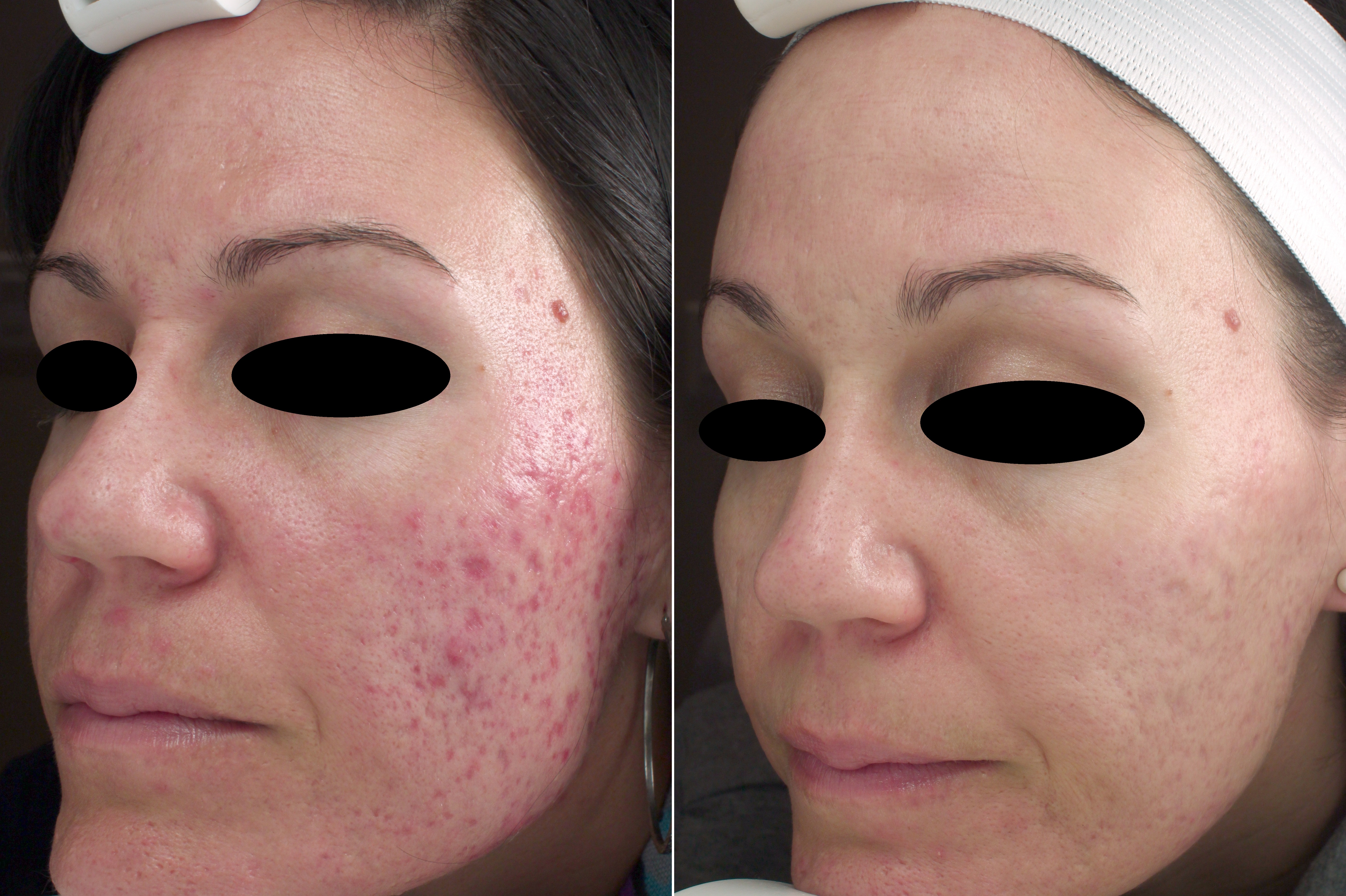 acne scar treatment pickering 
